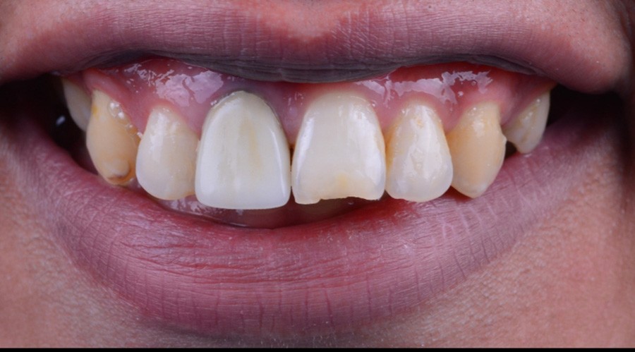 بعد تركيبات-اسنان